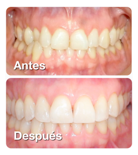 Antes-y-después